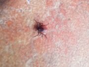 Рыбинск на втором месте в Ярославской области по активности клещей